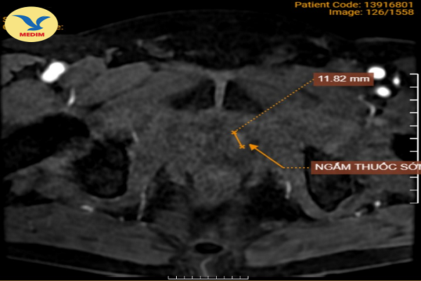 Chụp MRI phát hiện ung thư tiền liệt tuyến tại Bệnh viện Đa khoa MEDLATEC